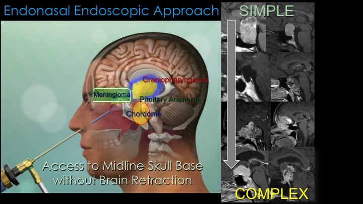 Keeping Cerebrospinal Fluid Leaks And Meningitis At Bay Pacific Neuroscience Institute 