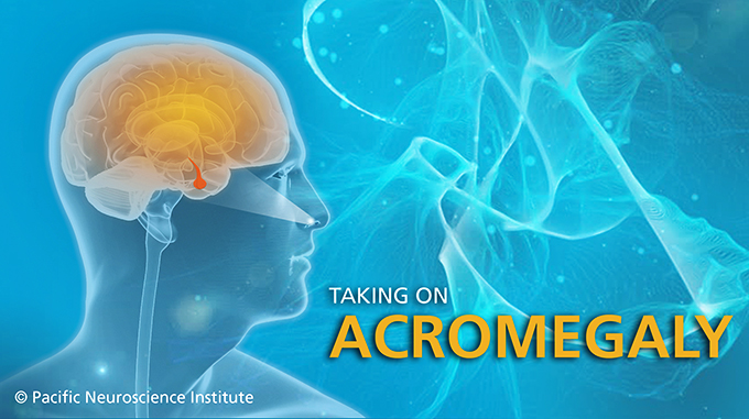 Acromegaly 101 Disease Diagnosis And Treatment Part 1 Of 2 Pacific