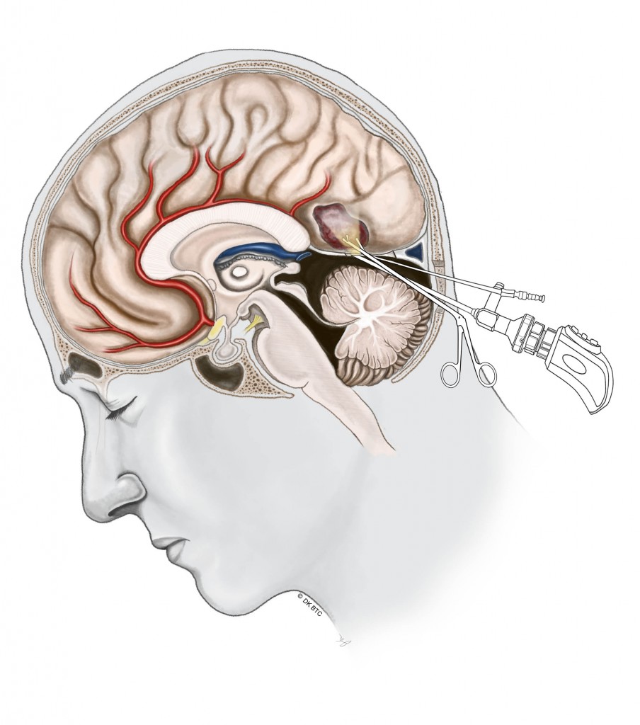 Minimally Invasive Brain Surgery | Keyhole Craniotomy | Brain Tumor Center