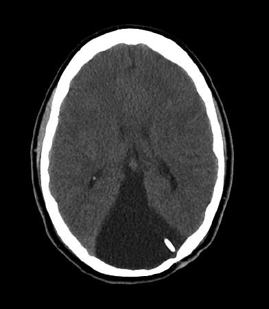 Direct Cystoperitoneal Shunt | Pacific Adult Hydrocephalus Center