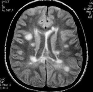 Multiple Sclerosis: Causes, Risk Factors, Symptoms and Treatment