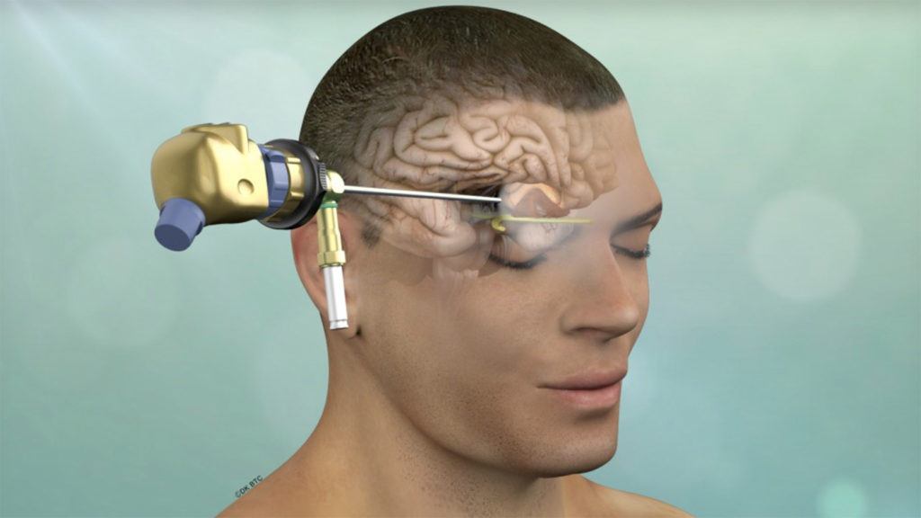 brain tumor surgery tools