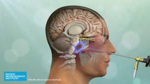 Chordoma: Symptoms, Treatment & Diagnosis | Pacific Brain Tumor Center
