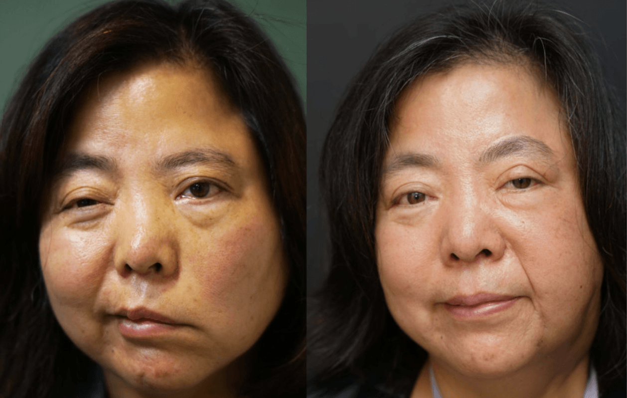 Facial Reanimation Surgery - Pacific Eye & Ear