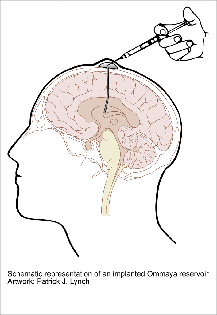 Ventricular Reservoir Placement | Pacific Adult Hydrocephalus Center