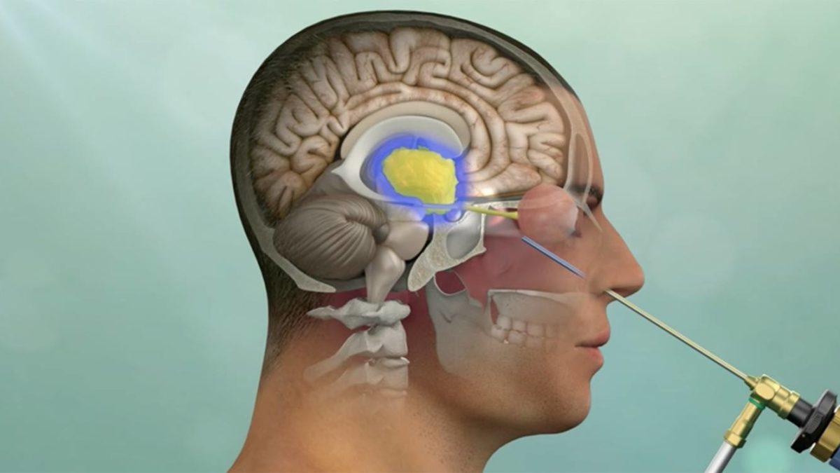 Pituitary Tumor Treatment And Surgery Pacific Pituitary Disorders Center