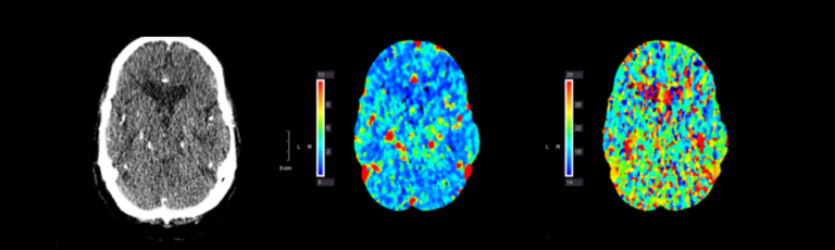 Brain Aneurysm Symptoms And Treatment Pacific Stroke And Neurovascular Center