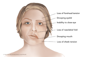 Ramsay Hunt Syndrome, Explained by Dr. Amit Kochhar - Pacific ...