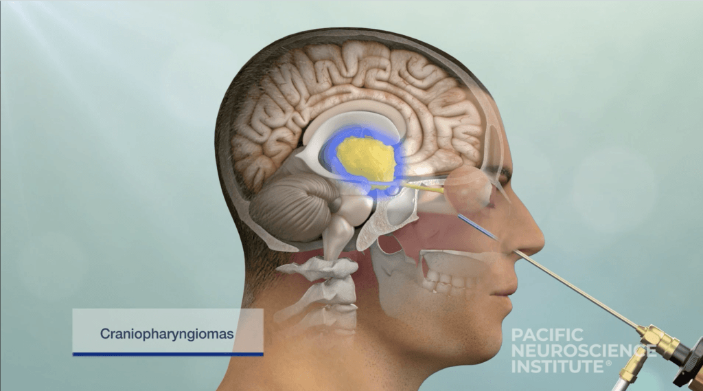 Intracranial Meningioma, The Common Brain Tumor | Pacific Neuroscience ...