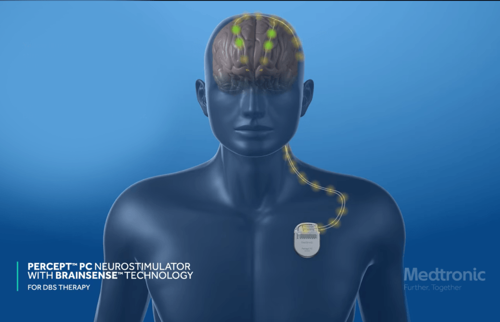 Innovative Deep Brain Stimulation Device Reads Brain Signals, Allowing ...