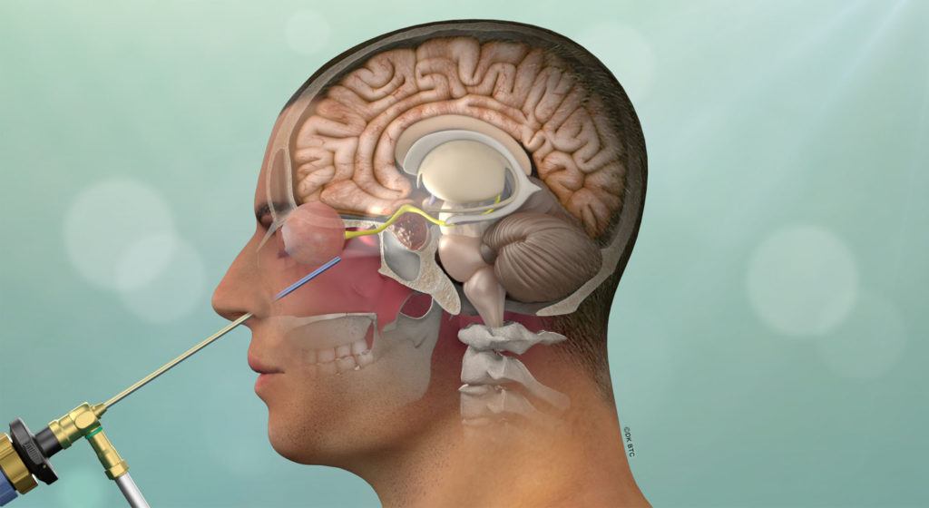 Cushing’s Disease 101 | Pacific Neuroscience Institute