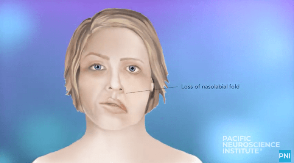 A Smile Returns After Facial Paralysis - Pacific Neuroscience Institute