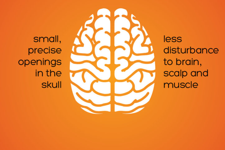 Keyhole Surgery for Brain Tumor Removal | Pacific Neuroscience Institute