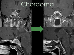 Chordoma A Rare Bone Cancer Of The Skull Base And Spine Pacific Neuroscience Institute