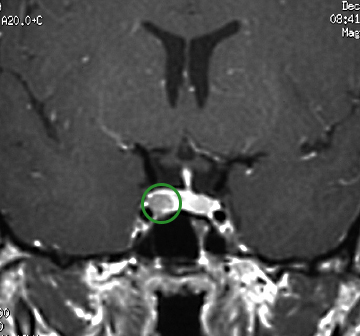 Cushing’s Disease 101 | Pacific Neuroscience Institute