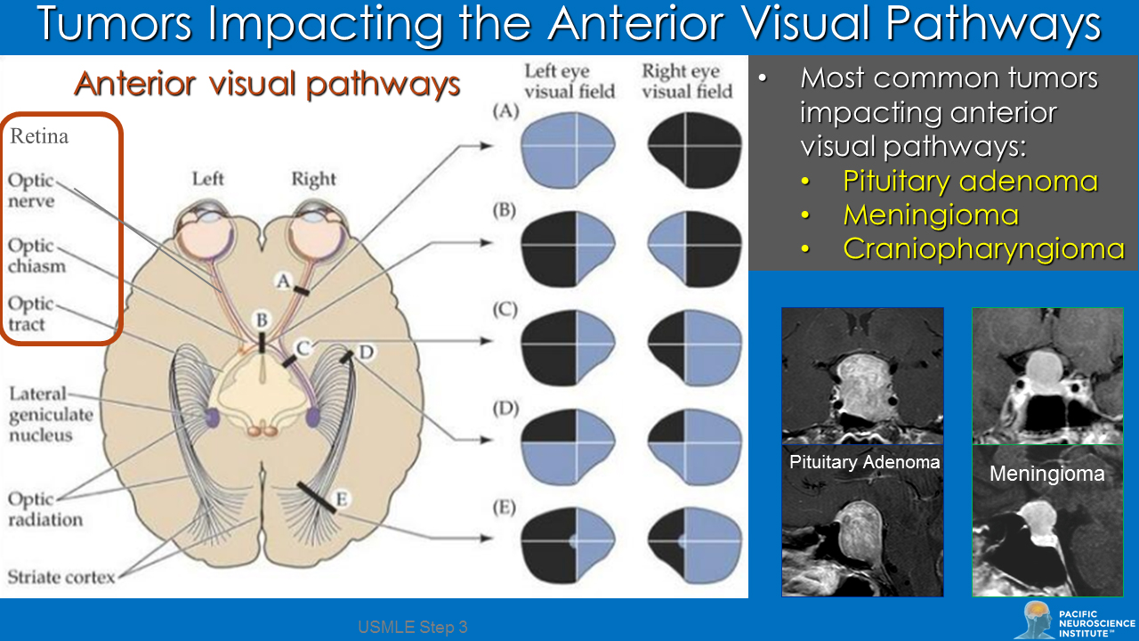 I Can See Clearly Now The Tumors Gone Pacific Neuroscience Institute 