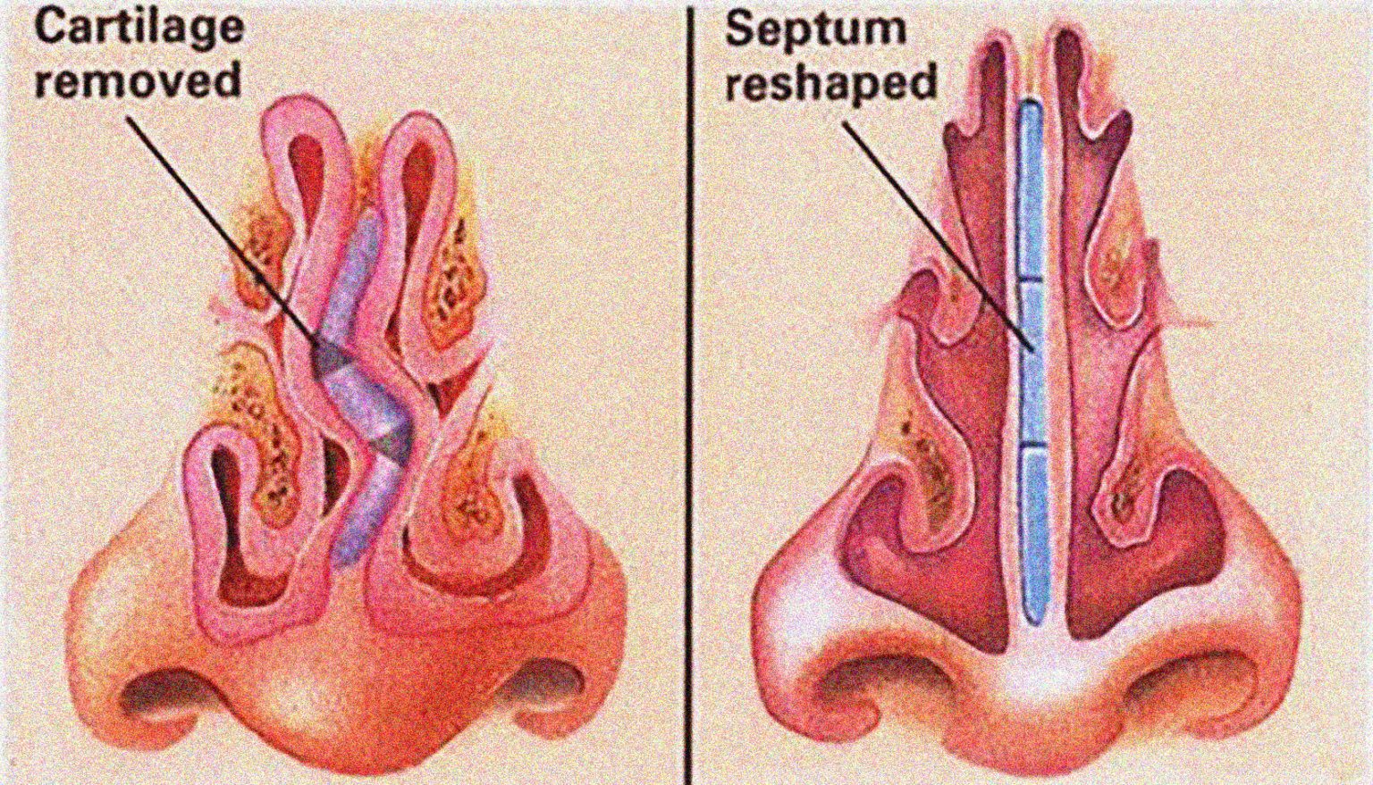 Is Your Nose Bent Out Of Shape? Maybe It's A Deviated Nasal Septum