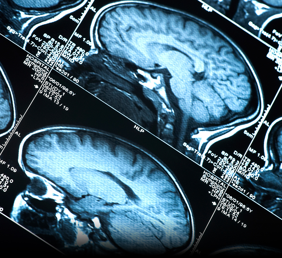 AD-NeuroScore: Our Innovative Approach to Alzheimer's Detection