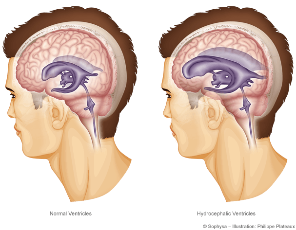 Hydrocephalus Disease Symptoms Causes And Treatments Pacific Adult Hydrocephalus Center