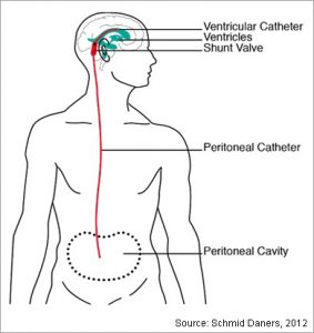 ventriculoperitoneal shunt complications