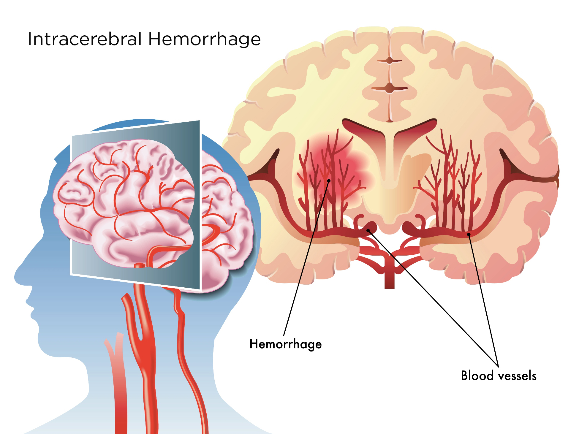 intraparenchymal hemorrhage