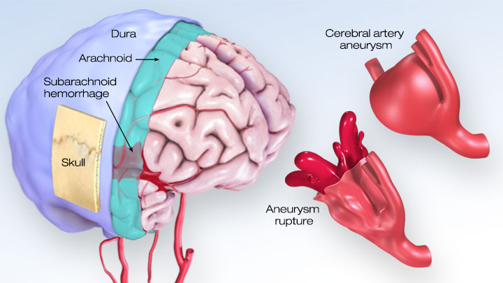 Brain Hemorrhage  Intracranial Hemorrhage - Causes, Symptoms
