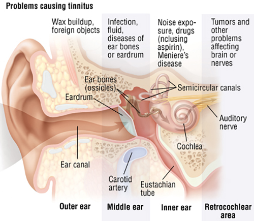 does everyone have tinnitus in silence