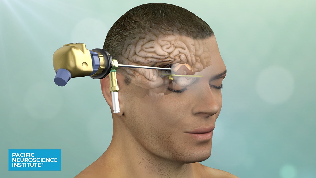 Brain Surgery Through the Eyebrow - Pacific Neuroscience Institute